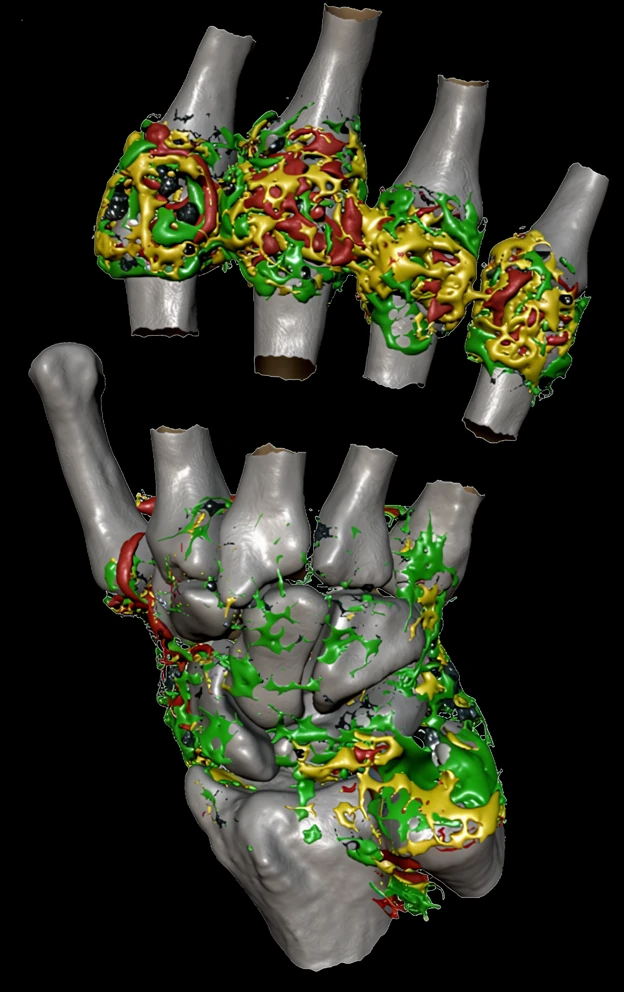 Inflammation imaging